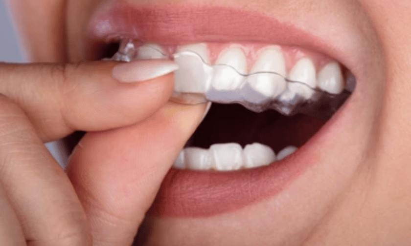 A Complete Guide To Invisalign Clear Aligners For Teens