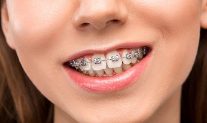 Braces in Mineola, NY