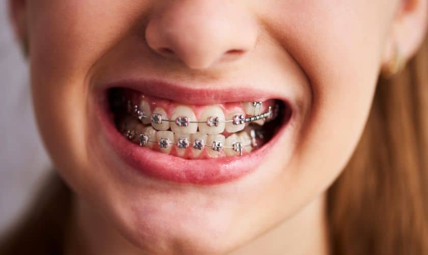 Braces in Mineola, NY