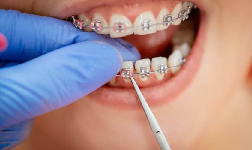 Investing In Yourself: The Cost And Benefits Of Adult Braces In Mineola